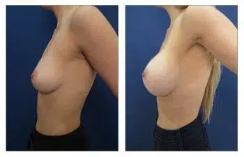 A woman's breast showcasing visible transformation post Breast Augmentation with Silicone implants.