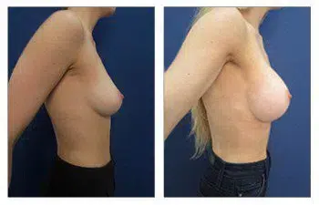 A woman's breast before and after breast augmentation surgery.