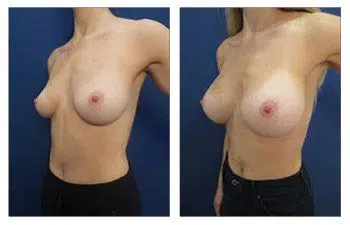 A woman's breast before and after breast augmentation surgery.