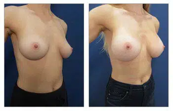 A woman's breasts before and after breast augmentation surgery, using silicone implants.