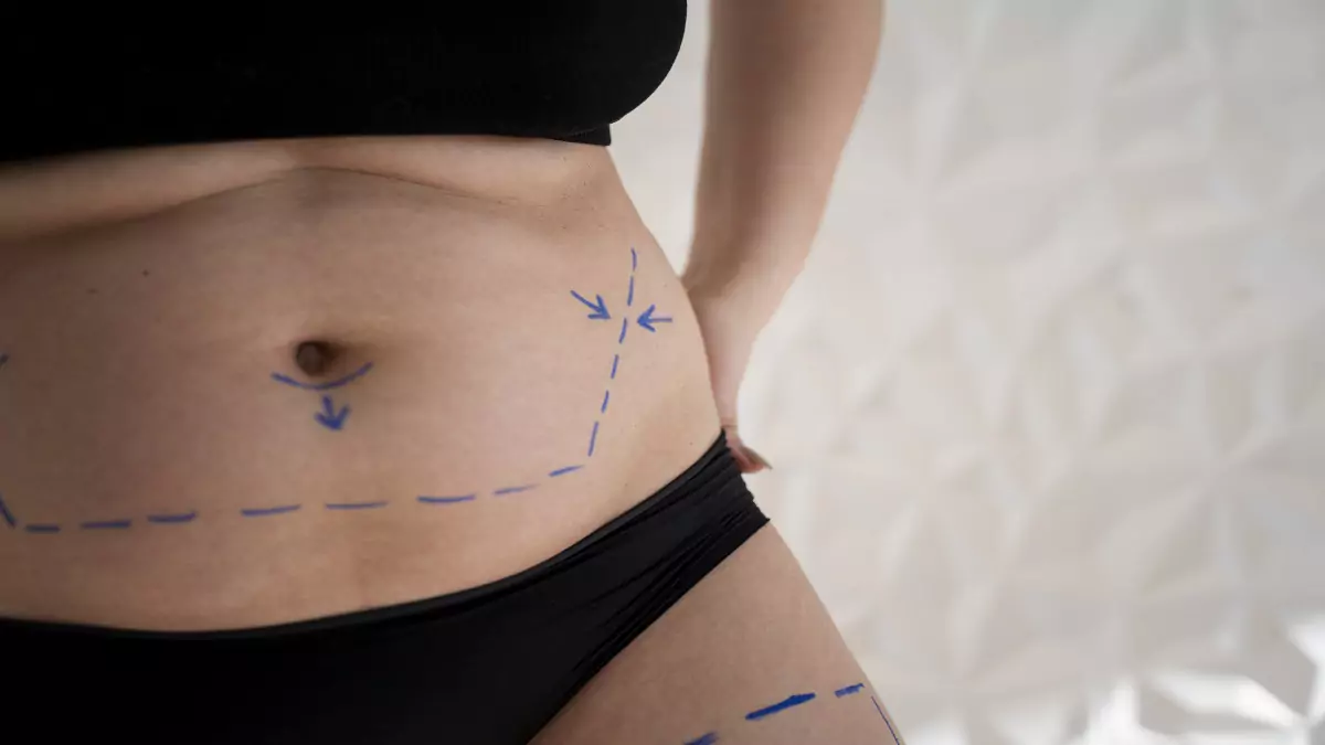 Does liposuction leave scars