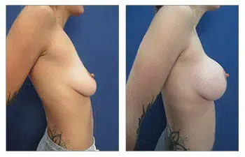 A woman's breast before and after breast implant surgery.