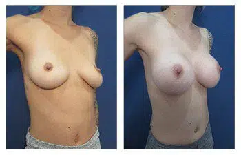 A woman's breast before and after surgery, considering ideal breast implants for enhancement.