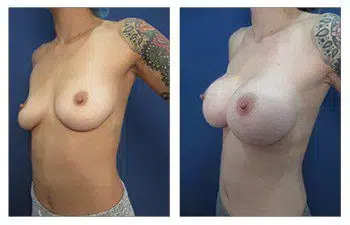 A comparison of a woman's breast before and after breast implants.