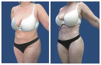 Liposuction Abdoominal Results