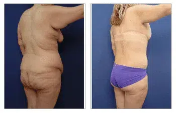 Post-bariatric body lift tummy tuck before and after.