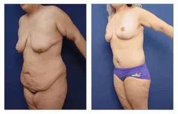 Post Bariatric Body Lift before and after.