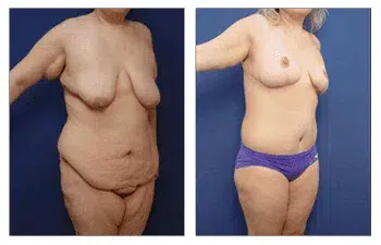 Tummy tuck before and after: How Painful is Post Bariatric Body Lift?