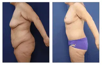 Tummy tuck before and after. Learn about the pain level of post-bariatric body lift.