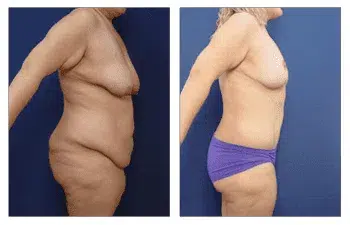 How Painful is Tummy Tuck Before and After?