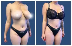 Before and after pictures of a woman's breast surgery.