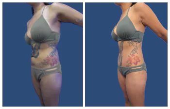 Liposuction Abdoominal Results.