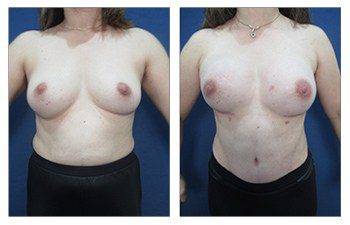 A woman's breast before and after breast reconstruction surgery.