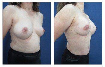 A woman's breast before and after surgery to undergo breast reconstruction.