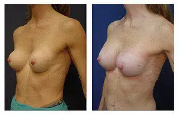 The Best Breast Band for Breast Augmentation - Explore the transformation of a woman's breast before and after surgery.