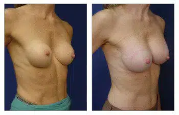         Description: A woman's chest before and after breast augmentation surgery, showcasing the effectiveness of The Best Breast Band.