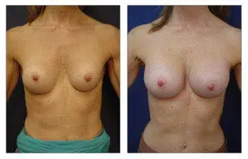 Before and after breast surgery, featuring The Best Breast Band for Breast Augmentation.