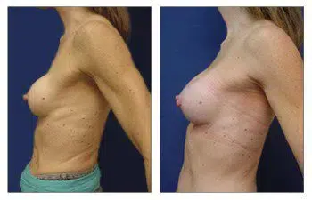 The best breast band for breast augmentation, showcasing a woman's breasts before and after surgery.