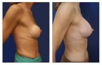 The Best Breast Band for Breast Augmentation showcasing a woman's breast before and after surgery.