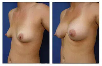 A woman's breast before and after Breast Implant surgery.