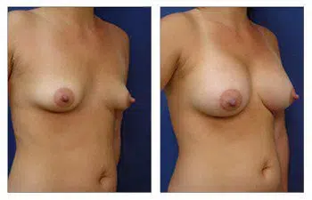 A woman's breast before and after Breast Implant surgery.