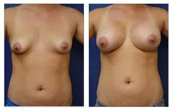 A woman's breast before and after Breast Implant surgery.