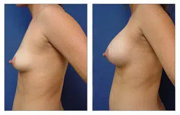 A woman's breast before and after breast implant augmentation.