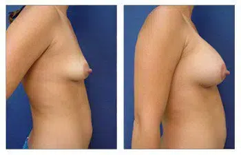 A woman's breast before and after undergoing breast augmentation with the use of breast implants.