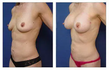 A woman's breast surgery before and after, featuring the expertise of Breast Implant Illness Doctors.