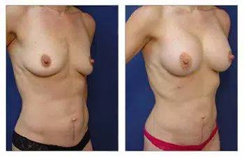 Before and after breast implant surgery, showcasing the transformation of a woman's breasts.