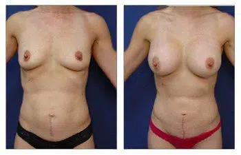 Explore the transformative results of a woman's breast surgery, showcasing the remarkable before and after pictures.