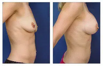 Breast Implant Illness - A woman's breast before and after surgery, guided by knowledgeable doctors.