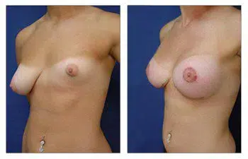 A woman's breast before and after surgery, focusing on Avoiding Breast Implant Malposition.