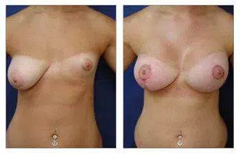 A woman's breasts before and after surgery, focusing on avoiding breast implant malposition.