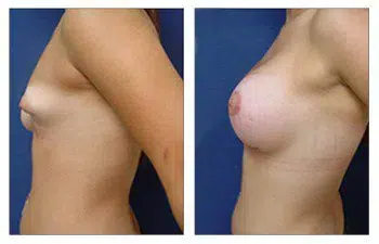 A woman's breast before and after surgery, highlighting successful avoidance of Breast Implant Malposition.