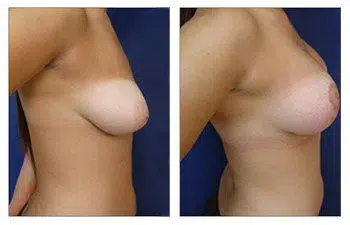 A woman's breast before and after surgery, ensuring Avoiding Breast Implant Malposition.