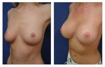 A woman's breast before and after undergoing surgery by the best breast augmentation surgeon.