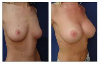 A comparison of the best breast augmentation surgeons.