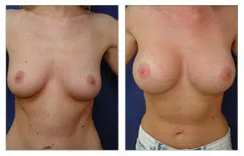 The before and after transformation of a woman's breast surgery performed by the best breast augmentation surgeon.