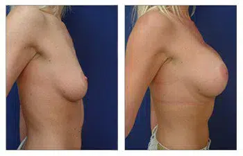 The transformation of a woman's breast before and after surgery, performed by the best breast augmentation surgeon.