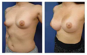 A woman's breast before and after Rapid Recovery Breast Augmentation surgery.