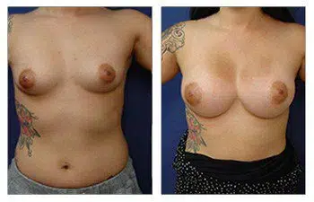 A woman's breast before and after undergoing Rapid Recovery Breast Augmentation surgery.