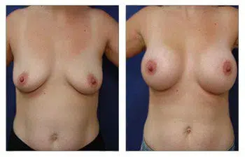 A woman's breast before and after undergoing breast augmentation surgery.