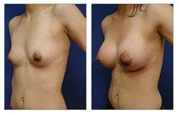 A woman's breast before and after **surgery with the safest breast implants**.