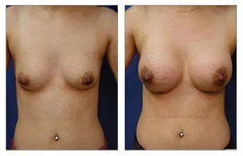 A woman's breast before and after the safest breast implant surgery.