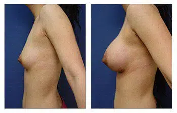 A woman's breast before and after the safest breast implant surgery.