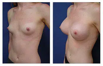 A woman's breast before and after surgery, highlighting the impact of minimizing incision line prominence during breast augmentation.