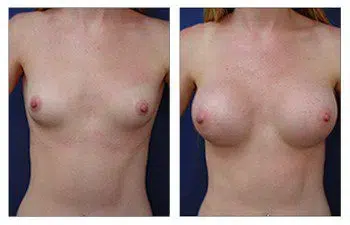 Minimizing incision line prominence during breast augmentation, the appearance of a woman's breast is showcased before and after surgery.