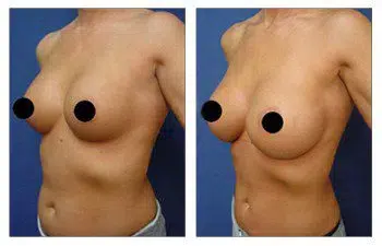 A woman's breast before and after a Breast Augmentation surgery revision to go bigger.