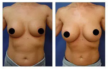 A woman's breast before and after a breast augmentation surgery.